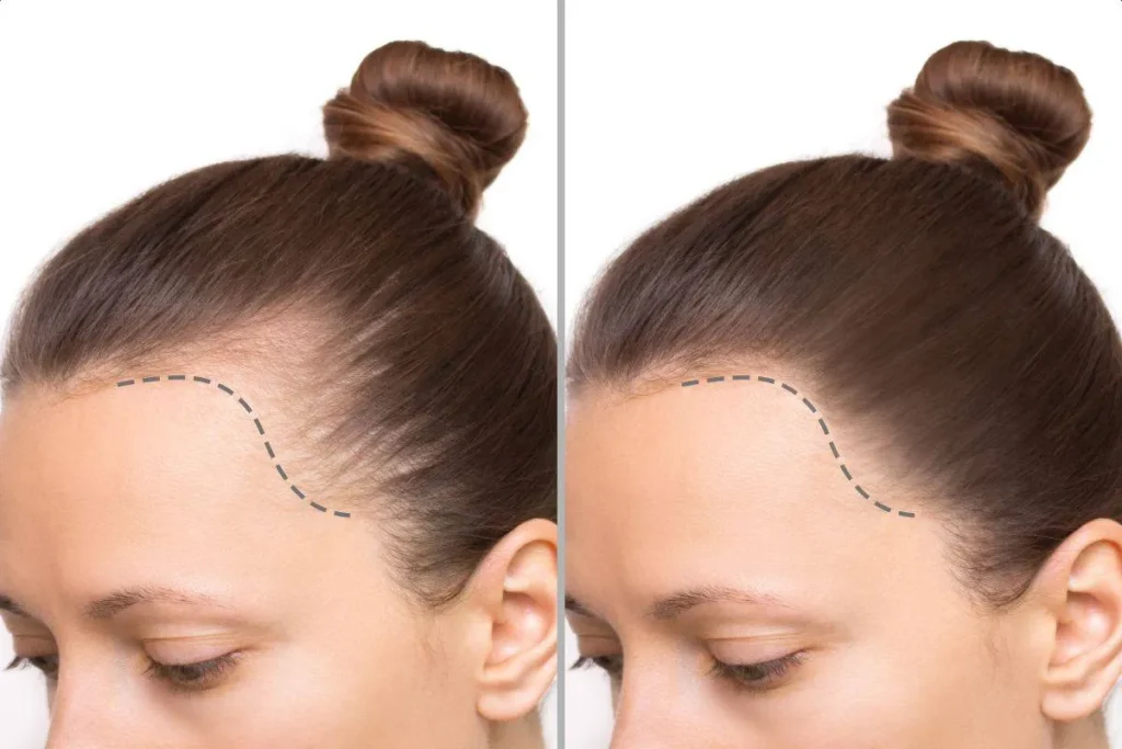 How To Fix Hairline Female: Effective Ways