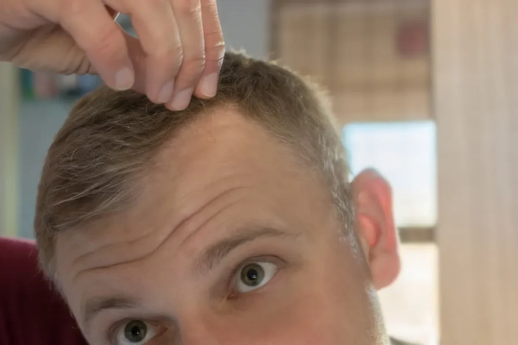 How To Fix Receding Hairline: Fast Solutions