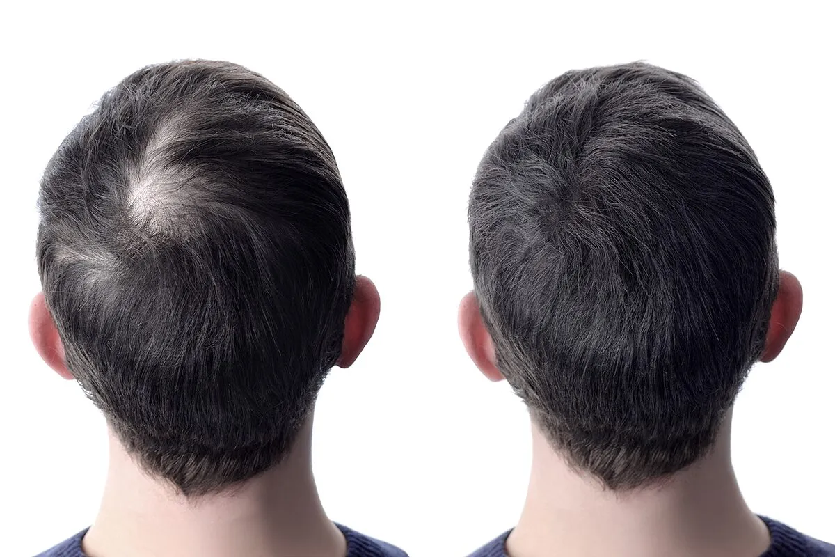 How To Increase Hair Growth For Men: Best