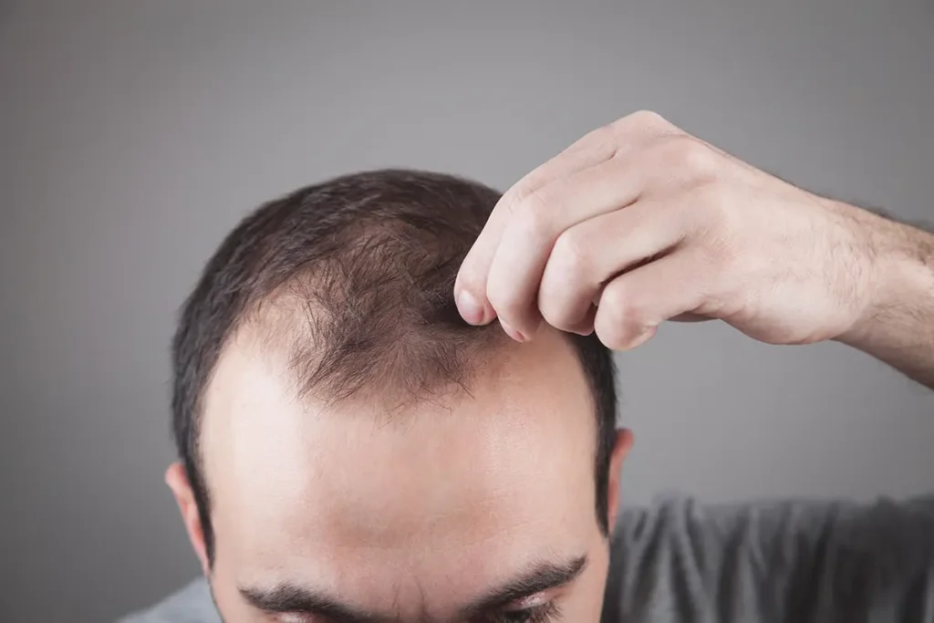 How To Know If You Have A Receding Hairline