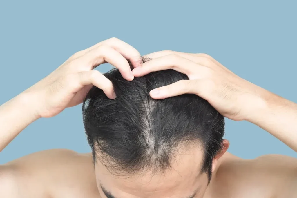 How To Prevent Hair Thinning Men: Power Guide