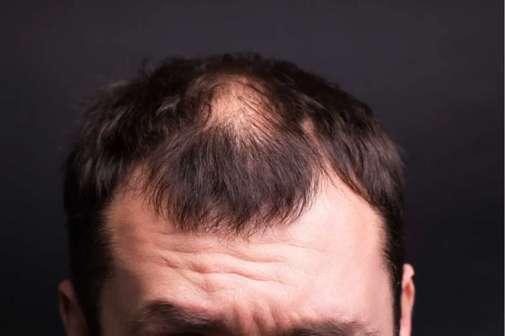 How To Prevent Hereditary Baldness: Expert Fix