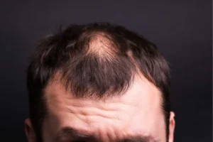 Common patterns of hair loss explained