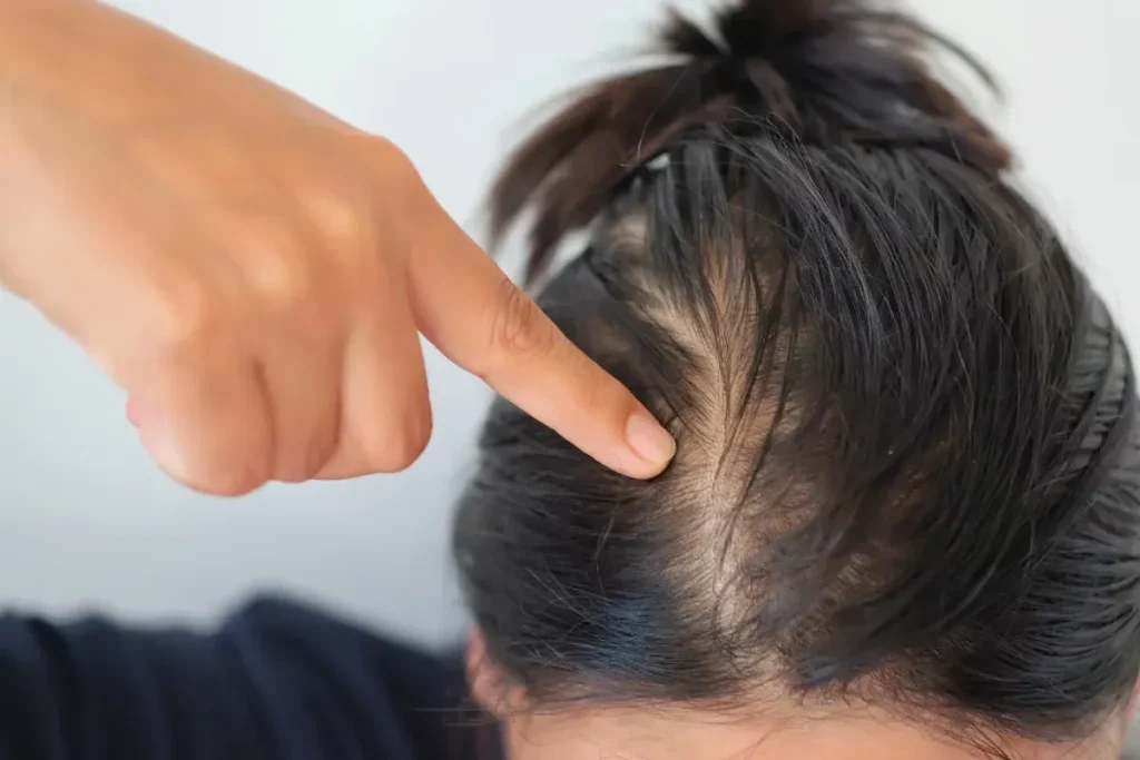 How To Regrow Thinning Hair Female: Power Way