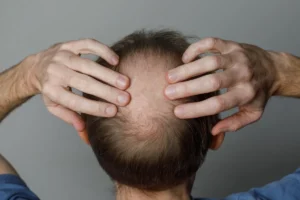 Hair growth cycle showing anagen, catagen, and telogen phases