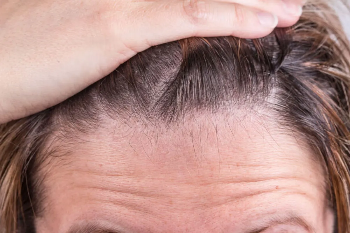 Hoe haaruitval in de menopauze stoppen: Beste