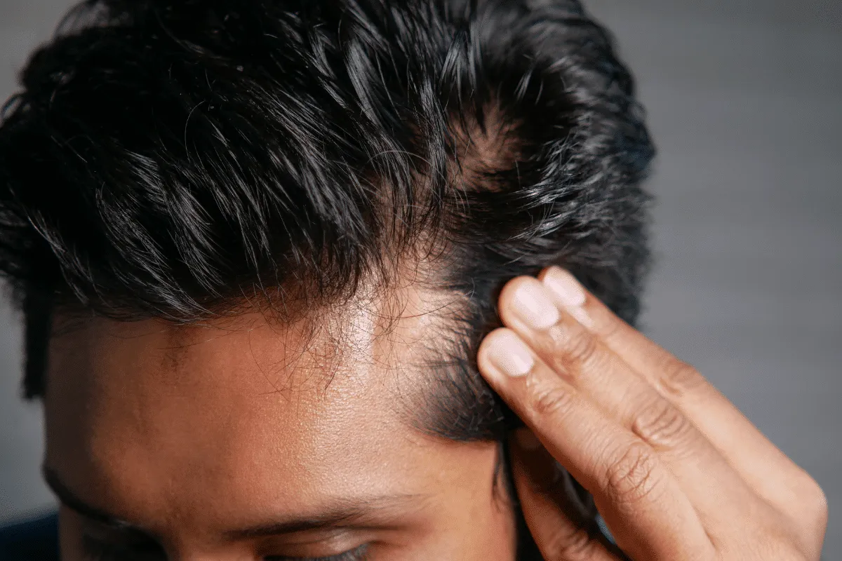 How To Stop Receding Hairline: Powerful Fix