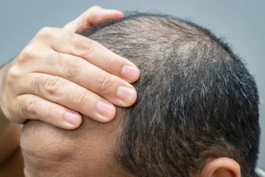 Hair growth cycle showing anagen, catagen, and telogen phases