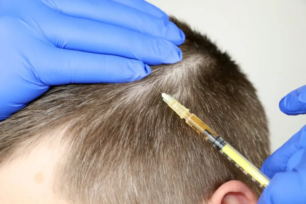 Hoe weet je of je haarlijn terugloopt? Tips