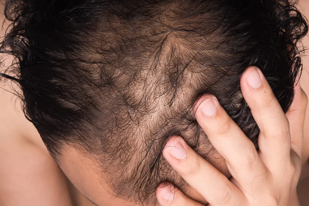How To Tell If Your Losing Hair: Quick Signs