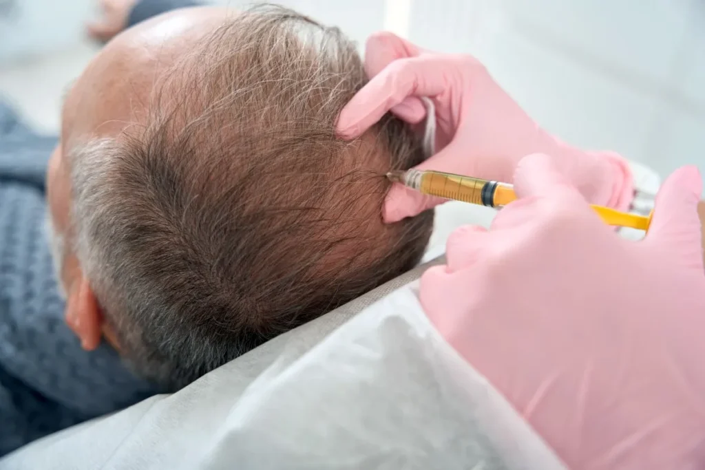 How To Treat Alopecia Naturally: Best Secrets