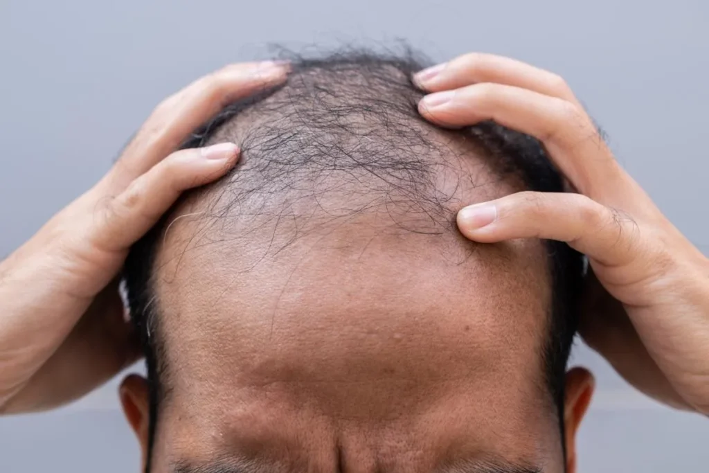 Is Finasteride over de toonbank? Slimme tips