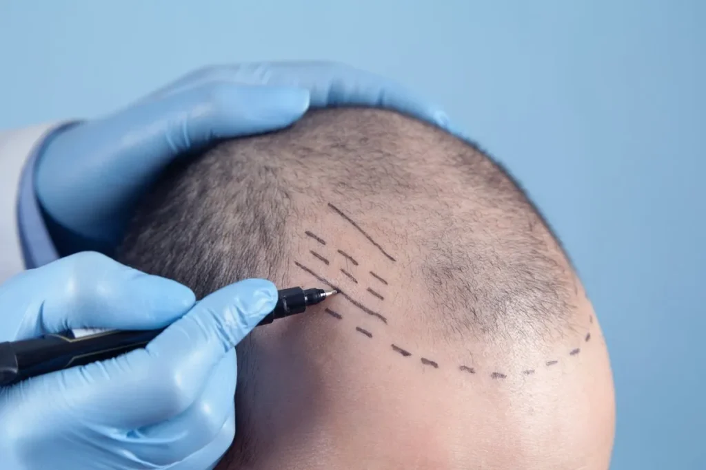 Is een haarvervanging permanent? Verbazingwekkende waarheid