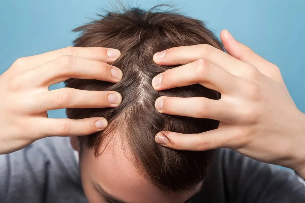 Itchy Scalp Hair Loss Treatment: Fast Relief