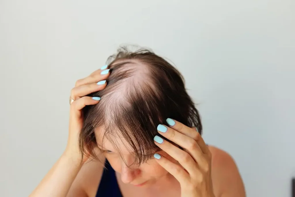 Kinds Of Alopecia: Essential Guide To Loss
