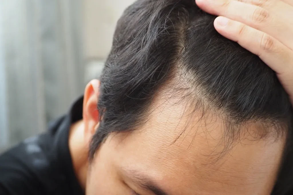 Losing Hair In Early 20s: Amazing Fixes