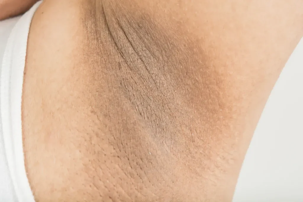 Losing Hair Under Arms: Shocking Reasons