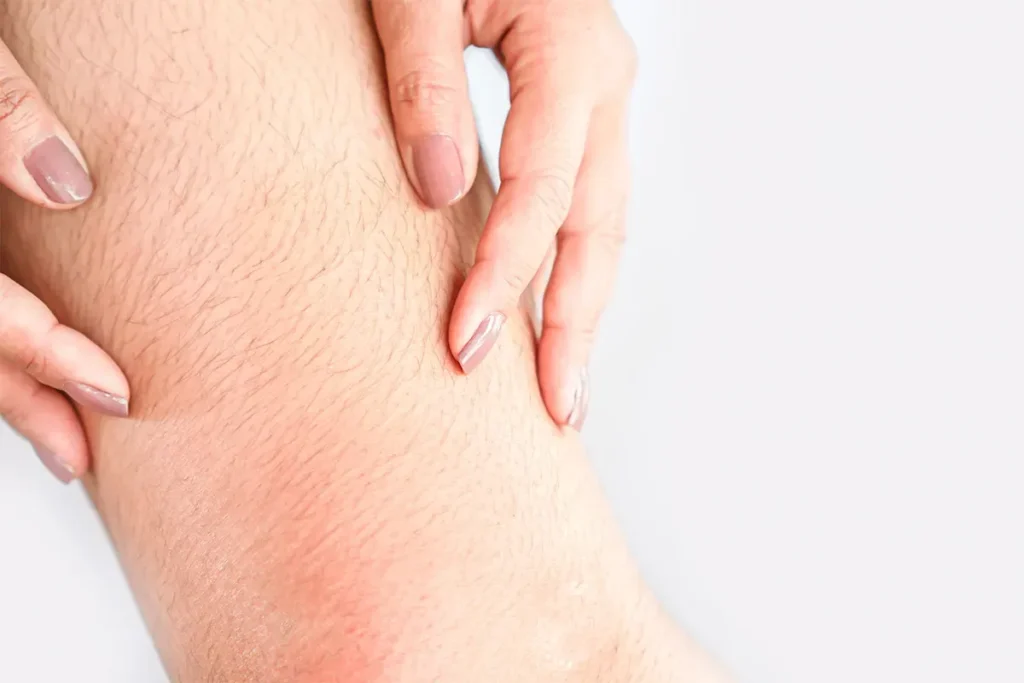 Loss Of Hair On Legs And Arms: Vital Info