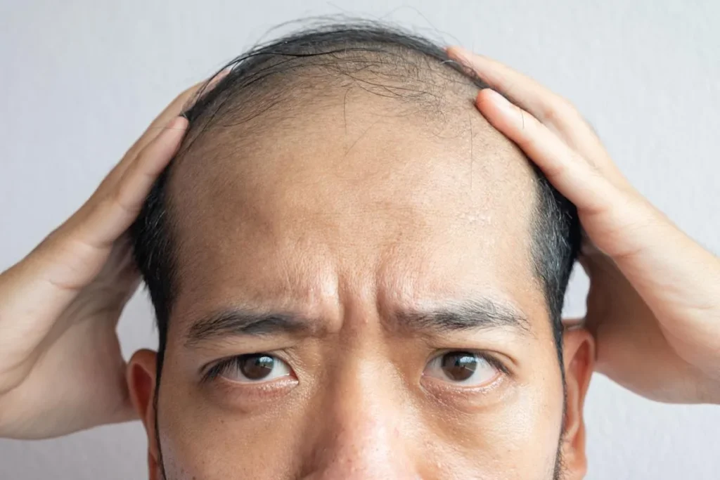 Male Baldness Stages: Essential Guide