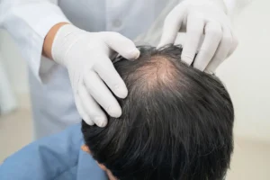 How Long Does Hair Regrowth Take? | Gold City Medical Center