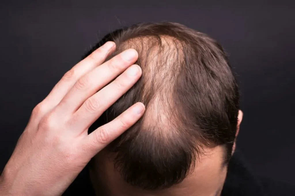 Male Or Female Pattern Baldness: Best Tips