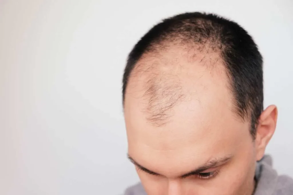 Male Pattern Hair Loss Stages: Top Guide
