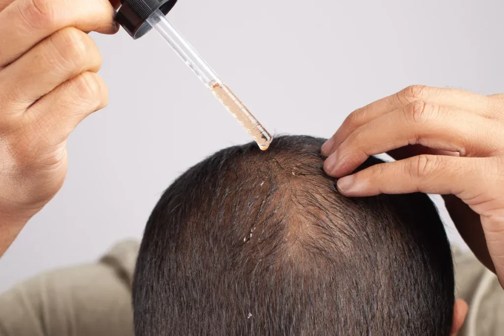 Minoxidil op haarlijn: Ongelooflijke resultaten