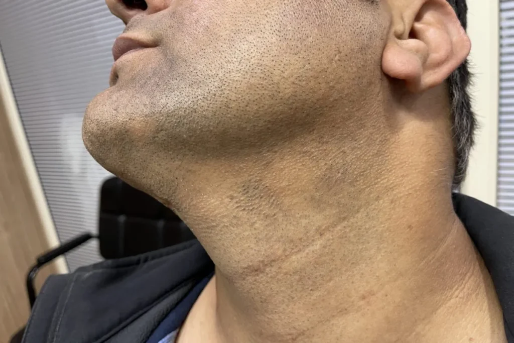 Kale plek snor: Verbazingwekkende snelle oplossingen