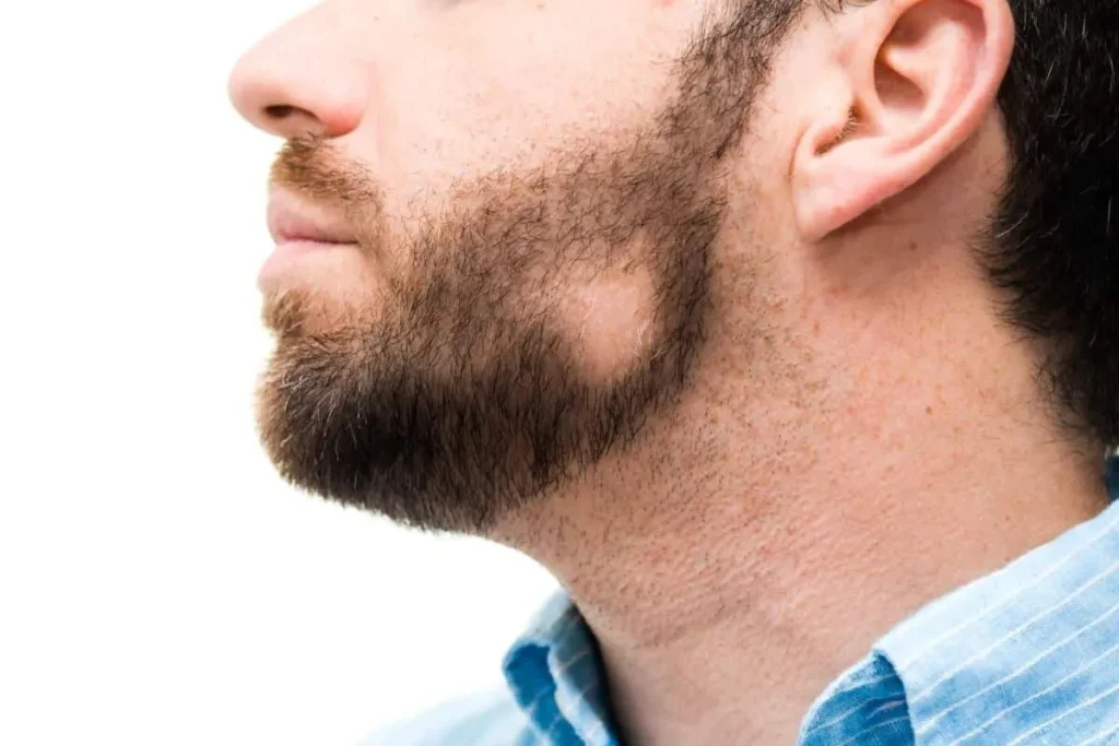 Kale plek snor: Verbazingwekkende snelle oplossingen