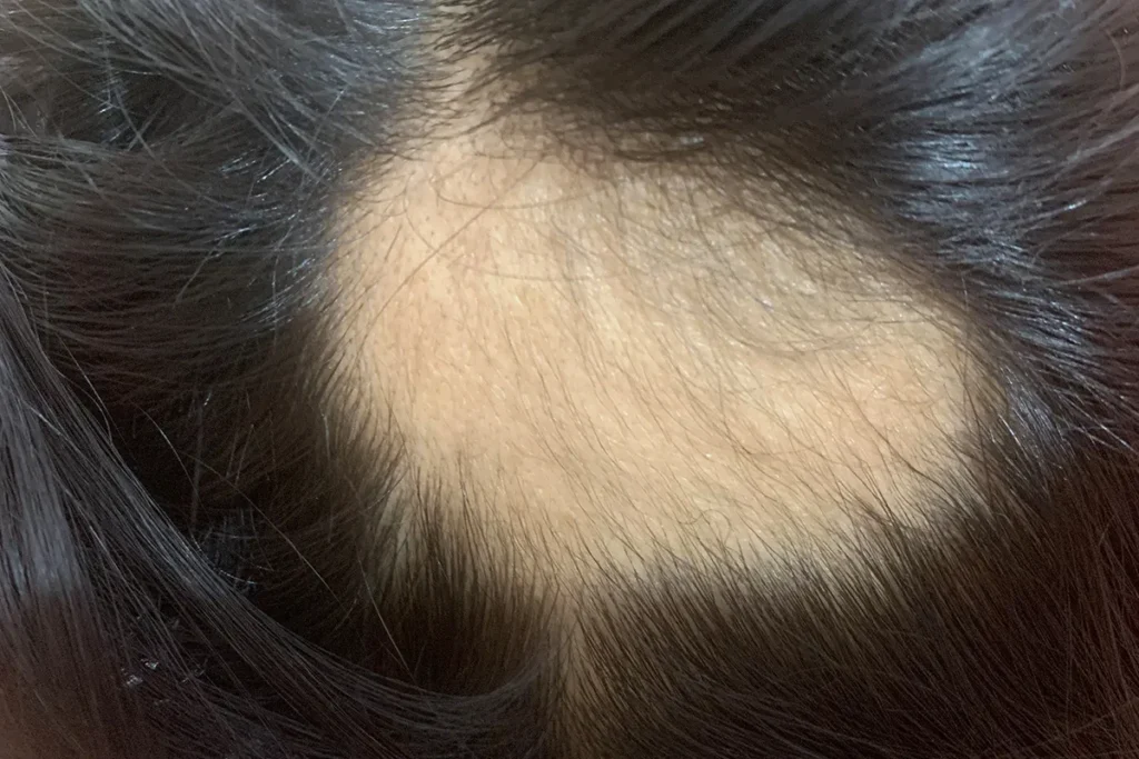 Natural Hair Growth Treatment: Best Way