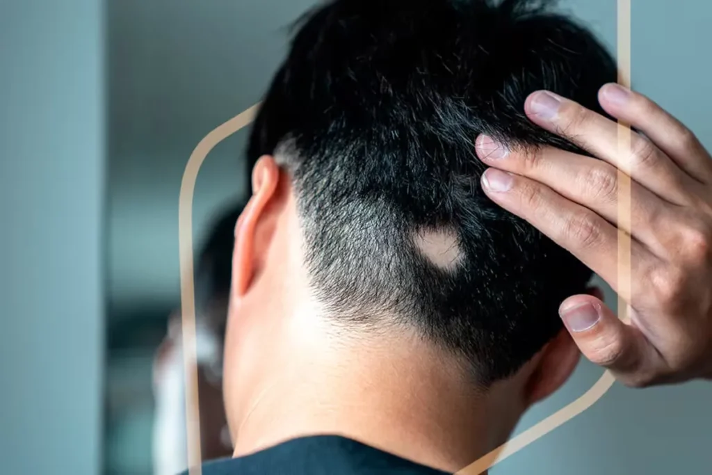 Nieuwe behandelingen voor dunner wordend haar: Power