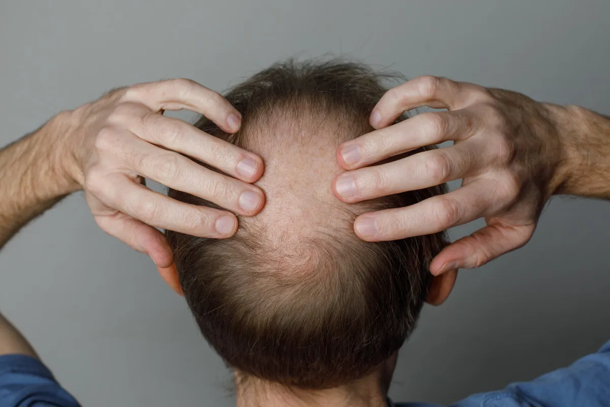 Gedeeltelijke haartransplantatie: Verbluffende resultaten