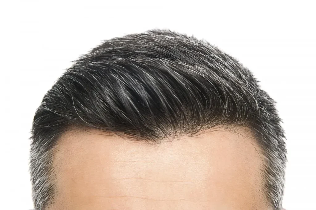 People With Bad Hairlines: Powerful Fix