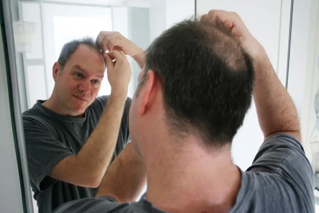 Prednisone Thinning Hair: Powerful Tips