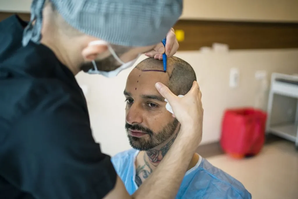 Receding Hairline Implants: Amazing Way