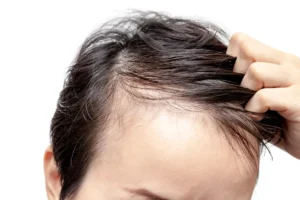 Common causes of side hair recession