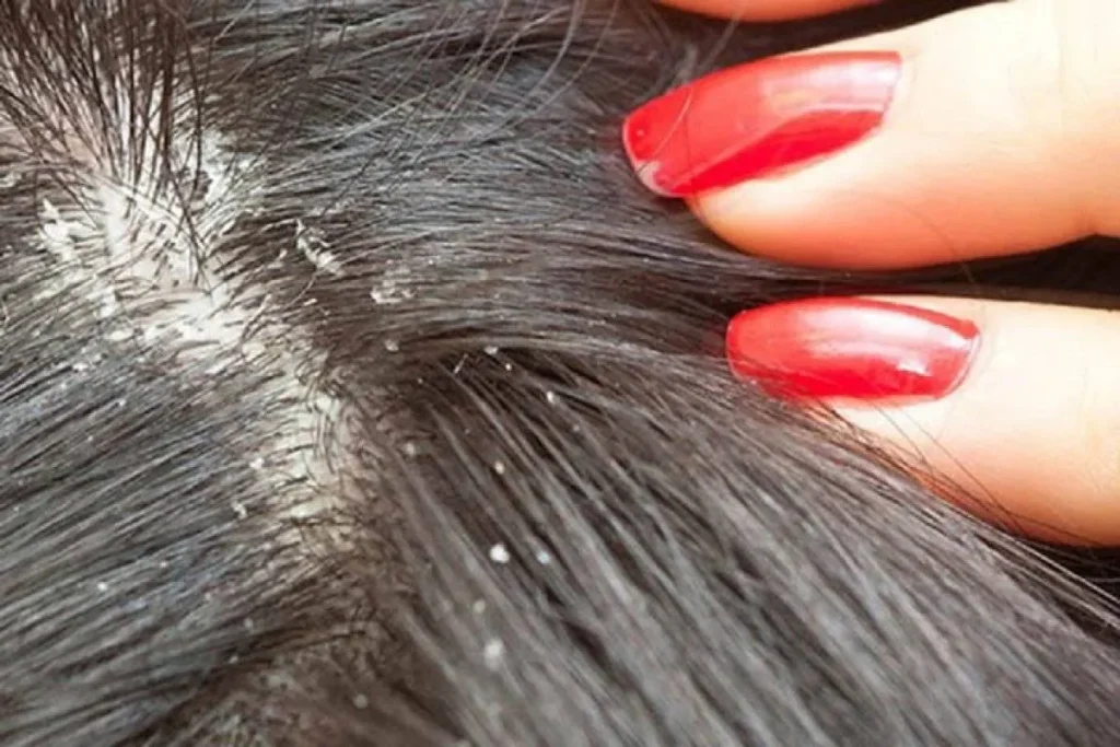 Rode vlekken op de hoofdhuid en haaruitval: Fix