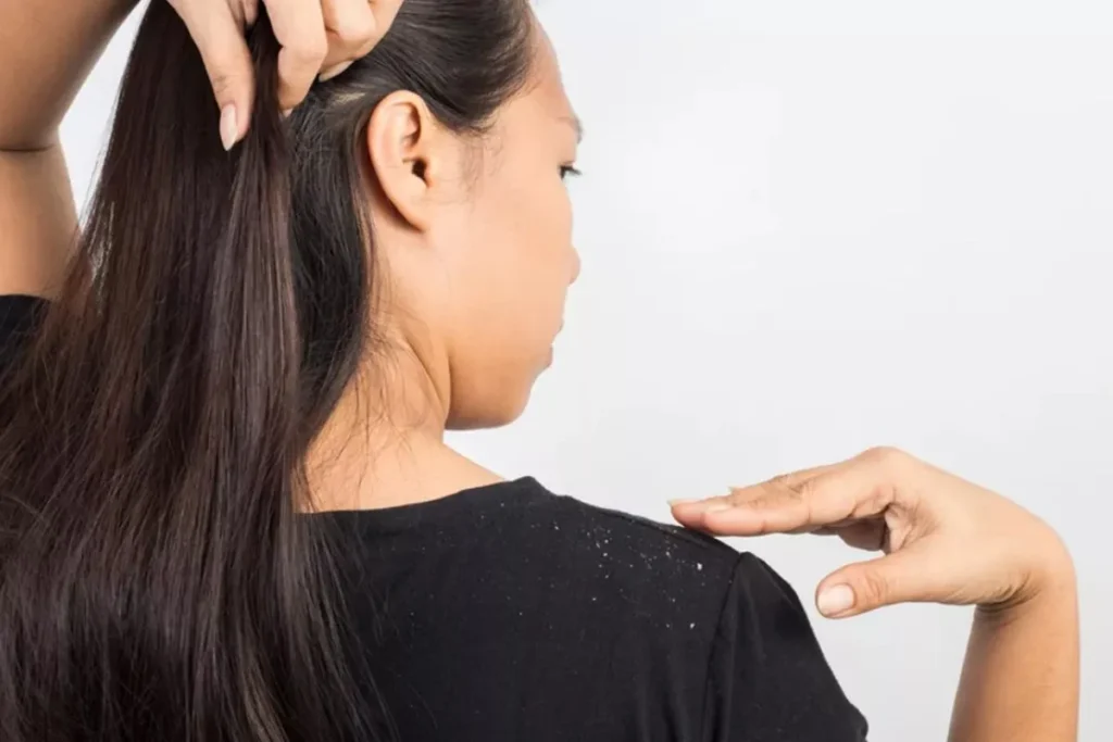 Rode vlekken op de hoofdhuid en haaruitval: Fix