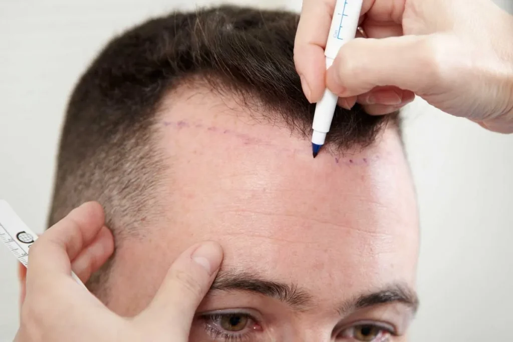 Shedding After Hair Transplant Surgery
