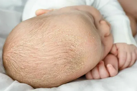 Kleine kale plek op hoofdhuid kind: Snelle hulp