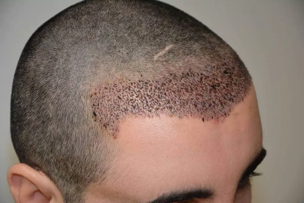 Small Hair Transplant: Amazing Results