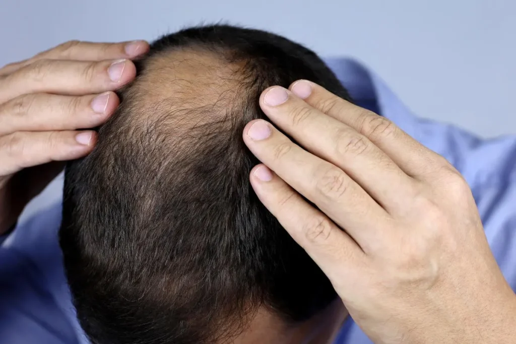 Stage 3 Hair Loss: Powerful Growth Fix