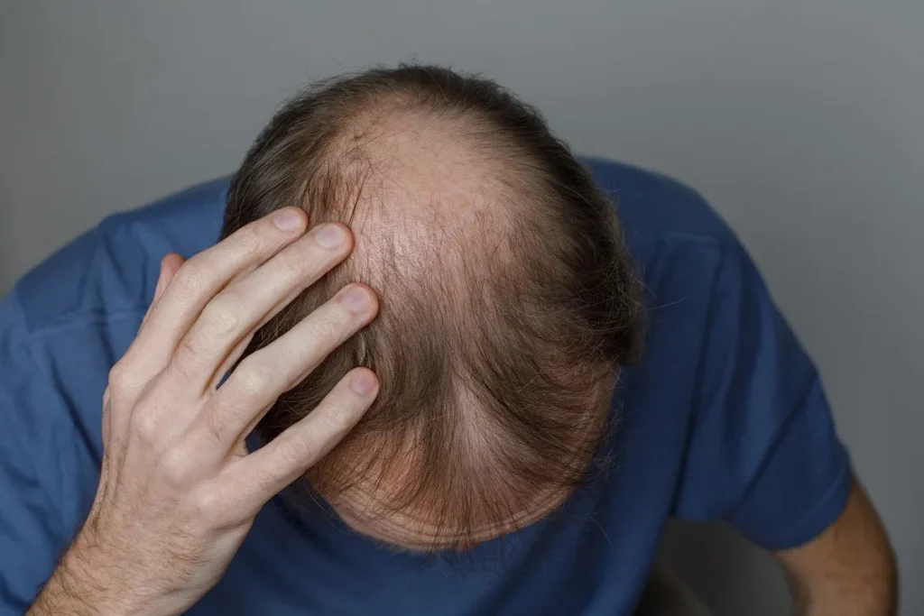 Stage 3 Hair Loss: Powerful Growth Fix