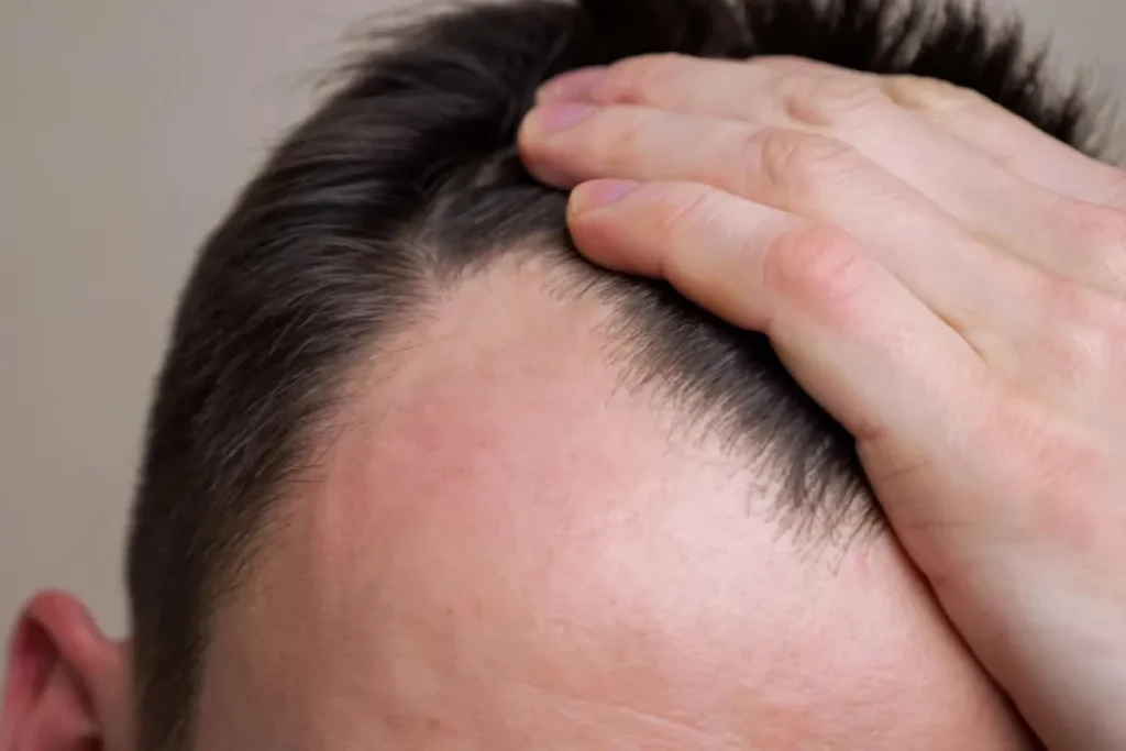 Fase 4 Kaalheid: Beste effectieve manieren