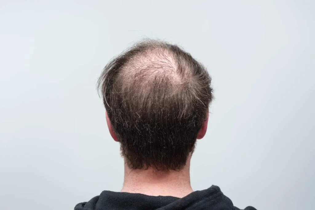 Stages Of Balding: Incredible Guide