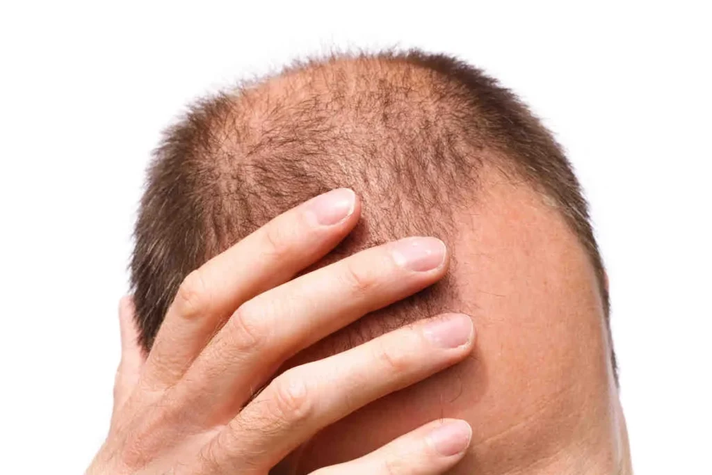 Stages Of Balding: Incredible Guide