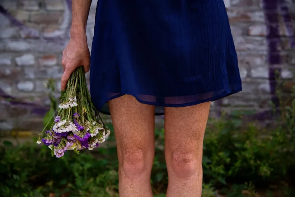 Sudden Loss Of Hair On Legs And Arms Female