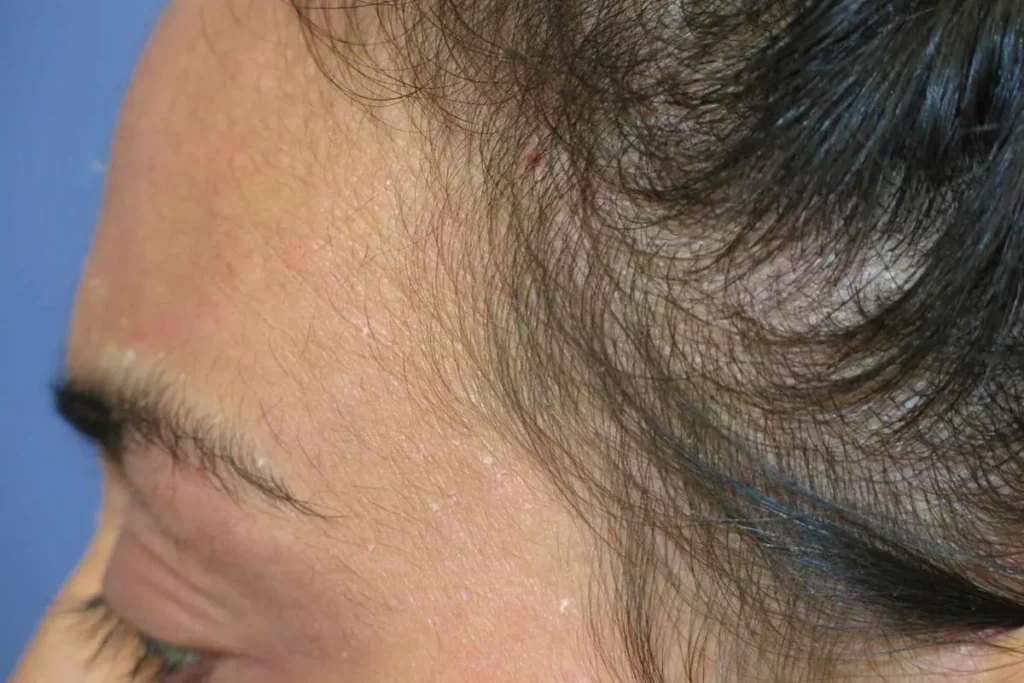 Telogen Effluvium Symptoms: Essential Facts