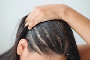 Common causes of front hair thinning