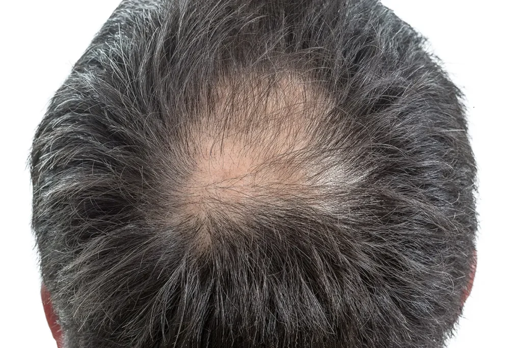 Thinning Hair Product: Amazing Results